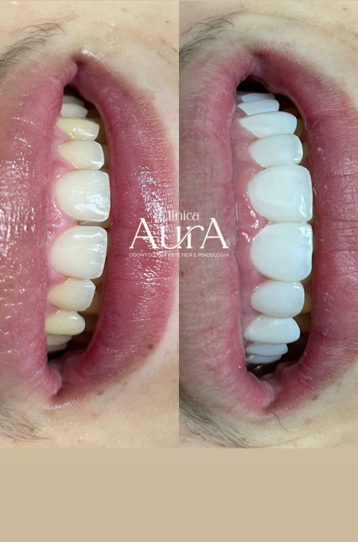 Antes e depois facetas em resina Uberaba